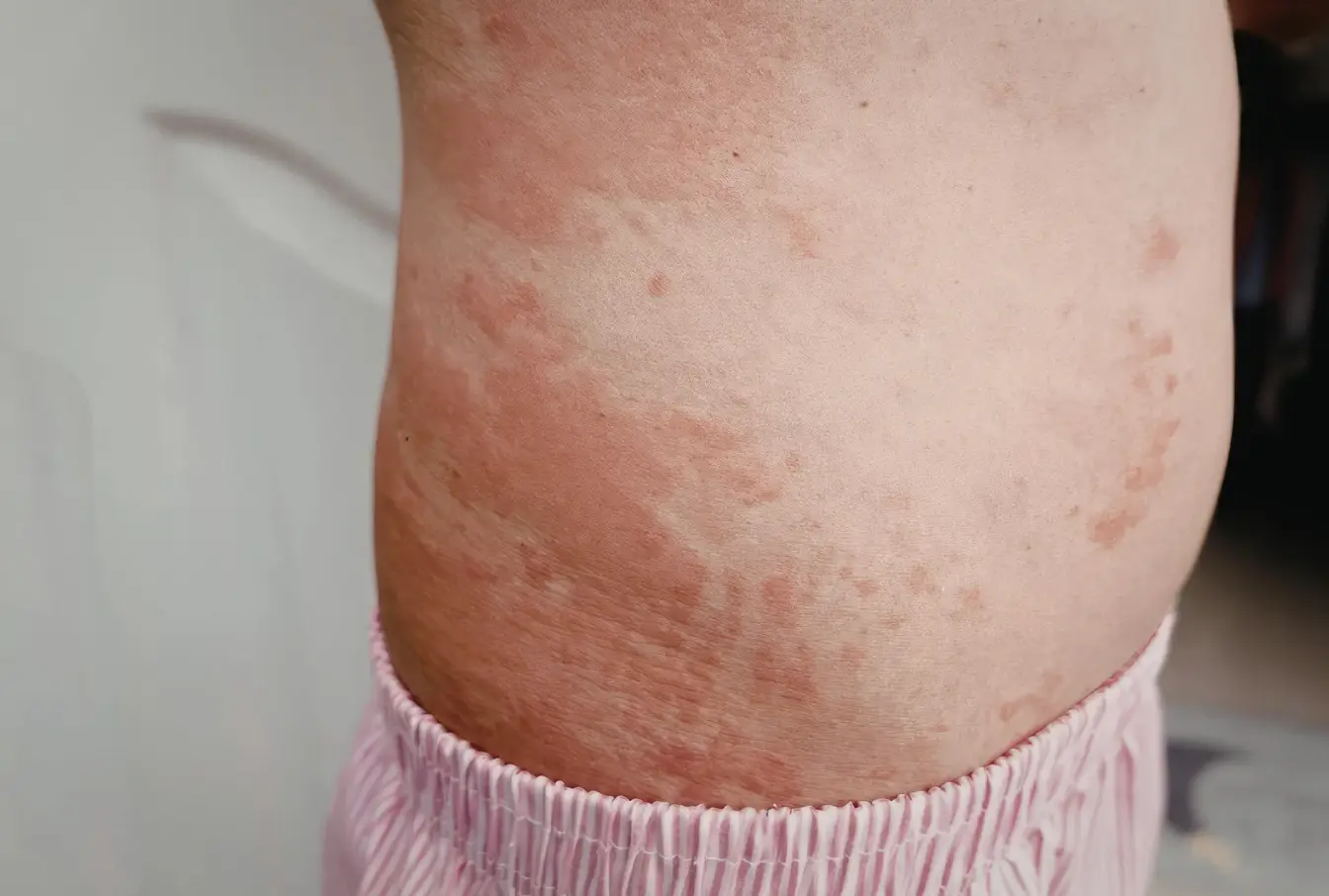 Skin reaction from mold exposure